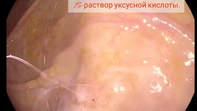 Как улучшить детекцию при проведении колоноскопии? Опыт городской клинической больницы № 6, Минск