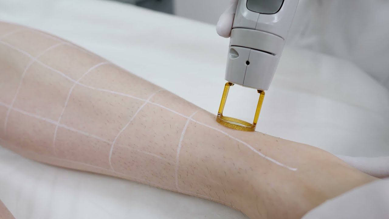 Лазерная эпиляция CANDELA GentleLase Pro