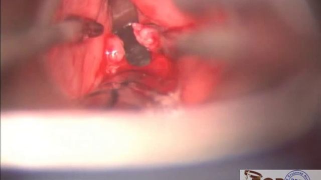 Удаление папилломы правой голосовой складки.