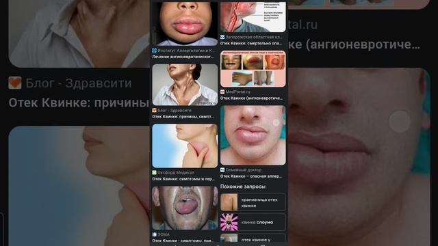 #квинка это аллергия?????????