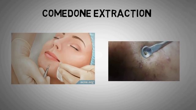 HOW TO TREAT ACNE AT HOME. Acne- All You Need To Know.