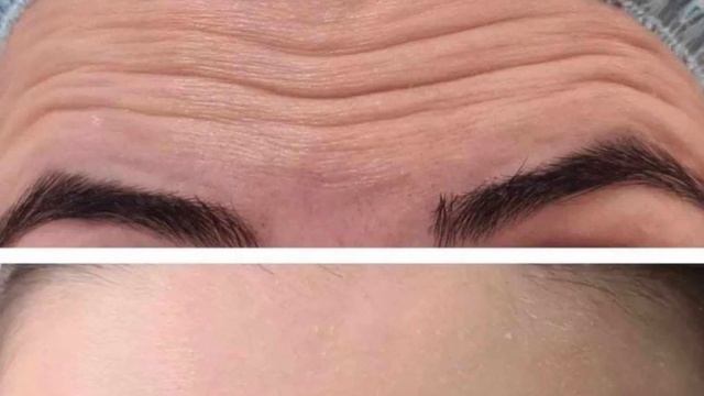 Диспорт Омоложение Косметология Казань