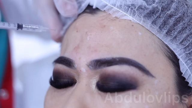 Ботулинотерапия лба и области вокруг глаз.  Peshona Va Ko’z Atrofiga Botulinoterapiya.