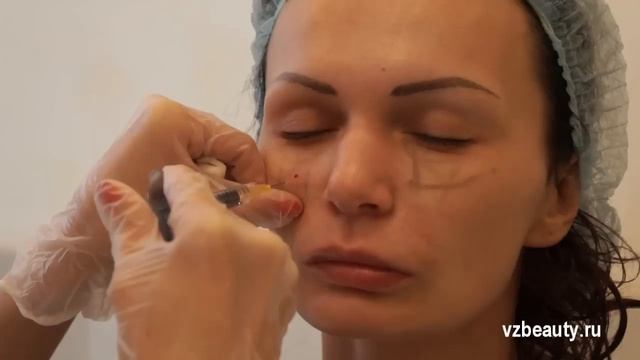 Носогубные складки, восполнение объема щек #5