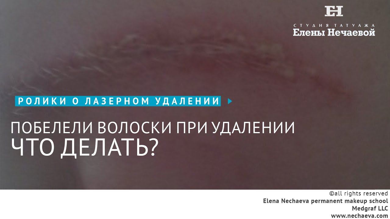 Побелели волоски при удалении. Что делать? #татуаж #лазерноеудаление