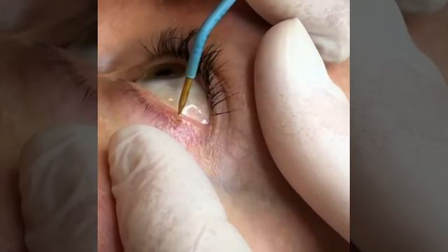 Удаление папилломы на нижнем веке без боли