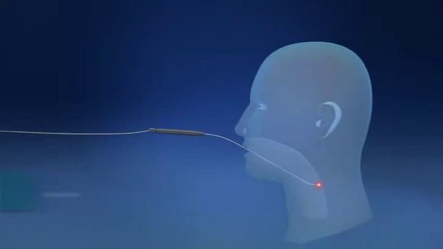 Аппарат ACUPULSE