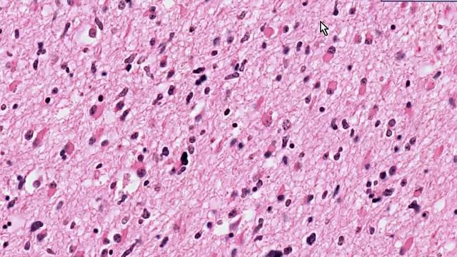 Histopathology Brain--Astrocytoma