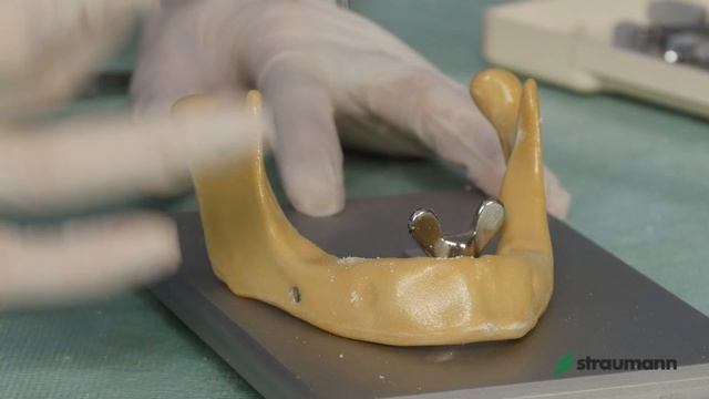 Установка имплантата: Straumann® Bone Level