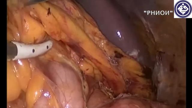 Лапароскопическая брюшно-анальная резекция прямой кишки