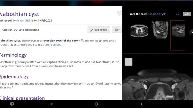 Наботова киста. Радиология.
