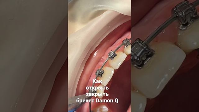 Как открыть / закрыть брекет Damon Q