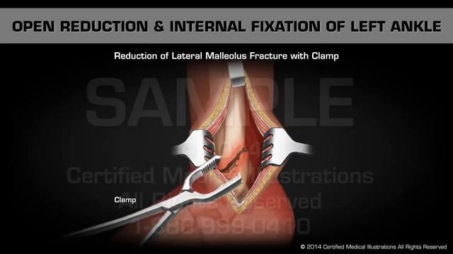 Открытая репозиция и накостный остеосинтез левой лодыжки
