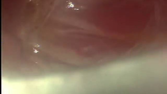 Симпатэктомия с помощью одного инструмента