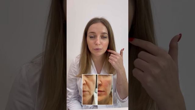 Как убрать носогубные складки? Врач косметолог. Санкт-Петербург.