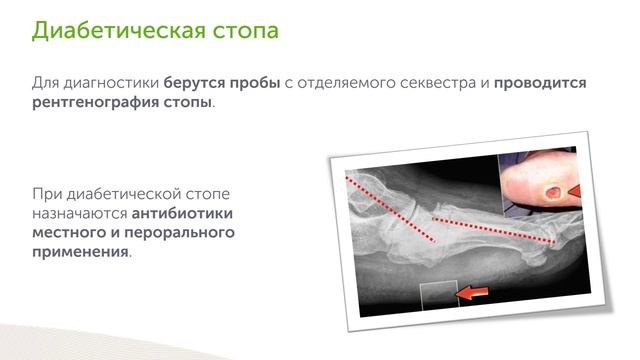 Антибиотики при сахарном диабете