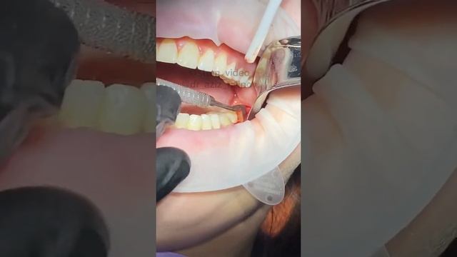 Удаление зуб мудрости