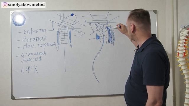 ЛФК при сколиозе эффективность