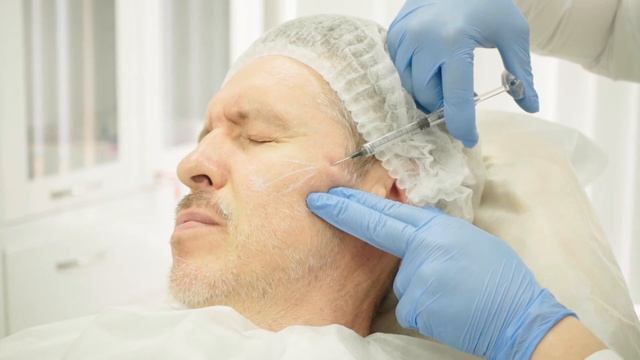 Коррекция носогубных складок Neauvia Stimulate Man и Intense