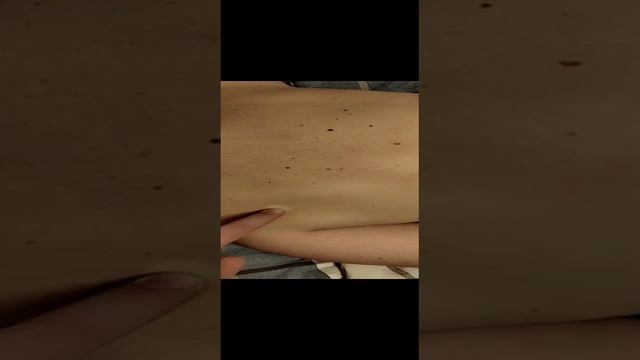 Плечелопаточный периартрит \ бурсит\  миозит