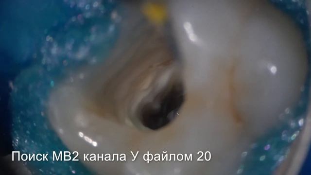 Поиск и обработка сложного МВ2 канала (Анатомия 2-1-2 по Вертуччи). Часть 2