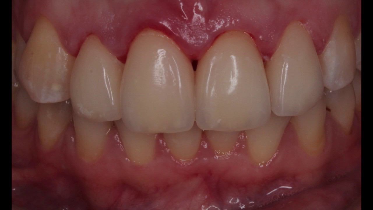 Депульпировать нельзя помиловать