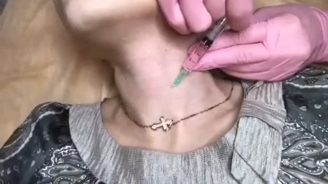 Инъекции Biomatrix  |  Биоматриксация шеи