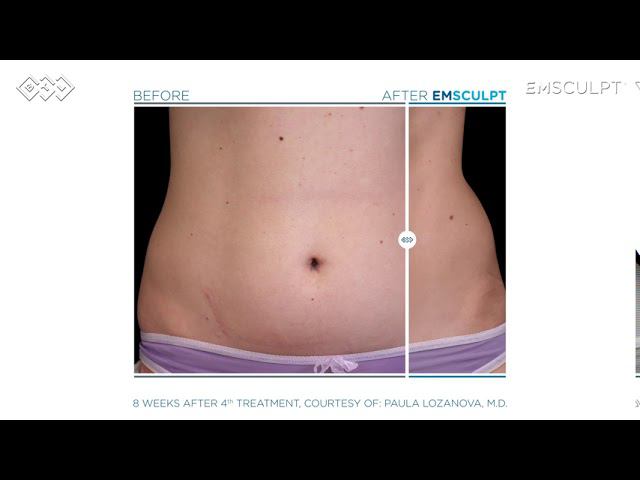 EMSCULPT: до-после