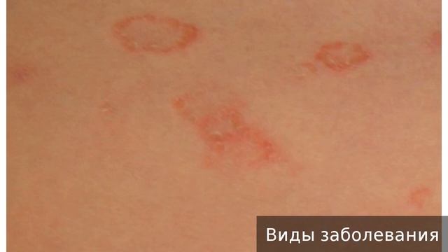 Паховая эпидермофития. Как лечить паховую эпидермофитию.
