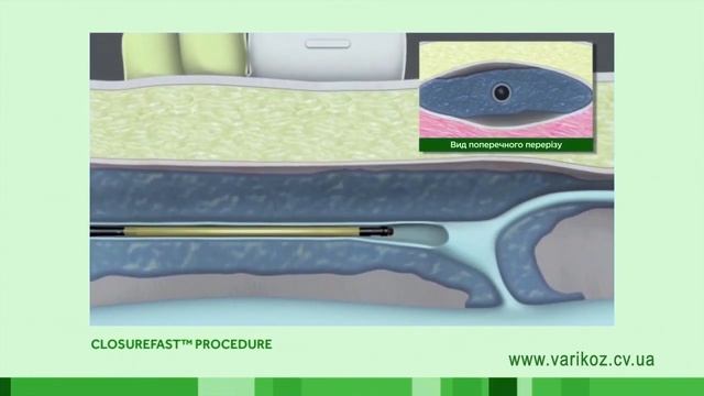 Радіохвильова облітерація (абляція) вен нижніх кінцівок