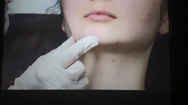 БОТОКС/ ЮВИДЕРМ / ПРАКТИКА/ РАЗУМОВСКАЯ. часть 3