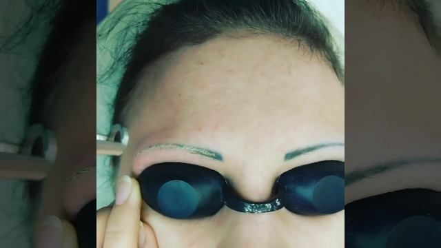 ЛАЗЕРНОЕ удаление татуажа