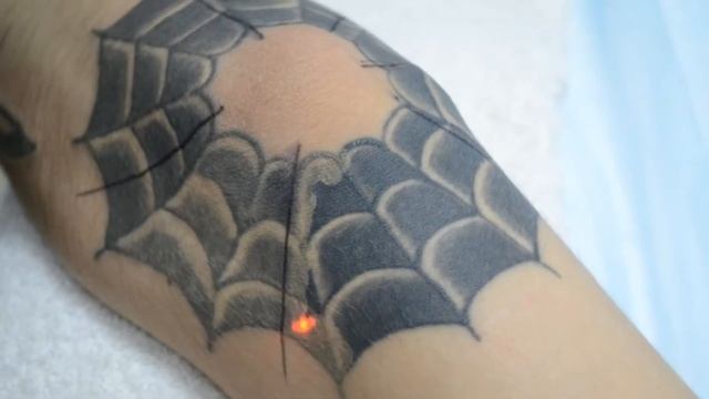 Удаление татуировок лазером Ростов на Дону