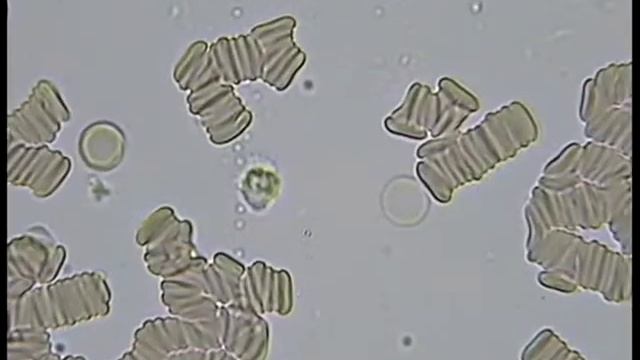 Гемосканирование,ребёнка 2-х лет, ацетон в моче .mpg