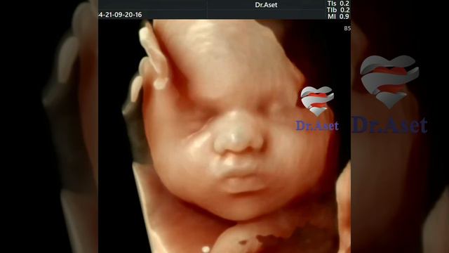 4D УЗИ .  Третий скрининг .