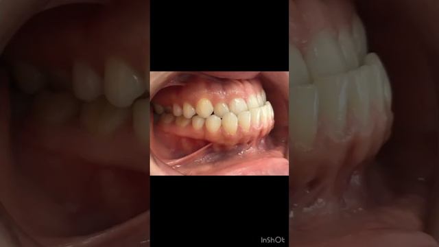 #ортогнатическаяхирургия #брекеты #внчс #ортодонтмосква