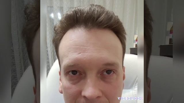 ботулотоксин до, и после )).