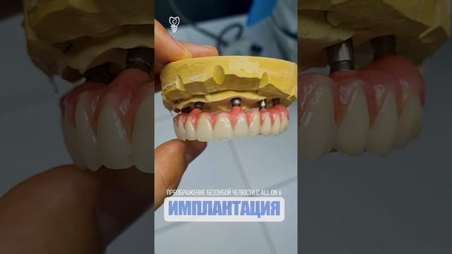 Преображение беззубой челюсти с ALL ON 6. Transformation Of Toothless Jaw With ALL ON 6Преображение
