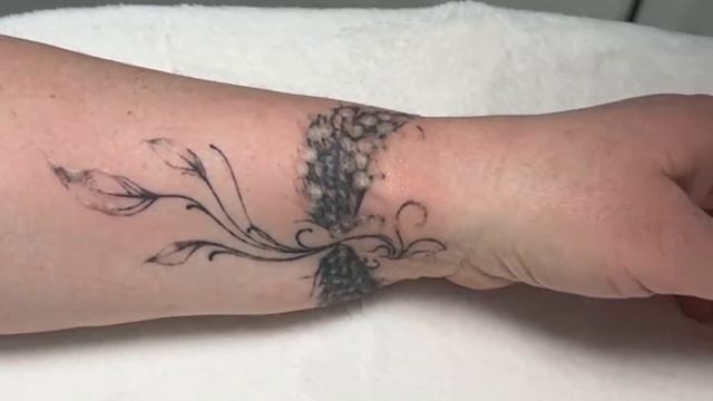 Удаление татуировки лазером сверх короткого импульса #удалениетату #неодимовыйлазер #удалениетатуаж