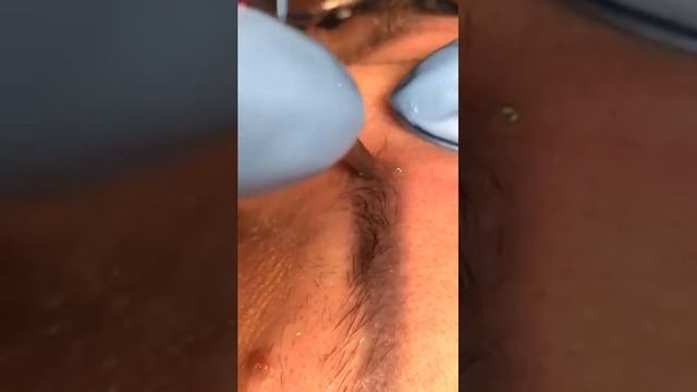 Удаление татуажа ремувером