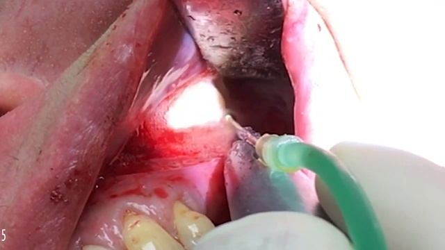 Ревизия дна гайморовой пазухи, синус-лифтинг, пластика мембраны Шнейдера. Профессор Орлов А.А.