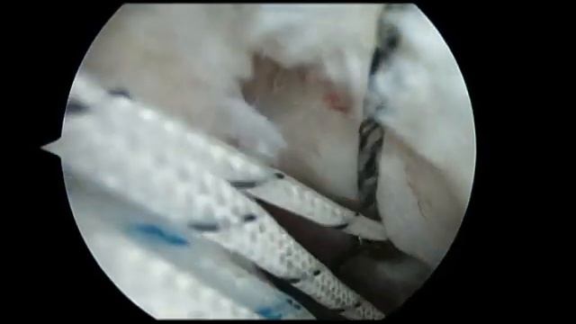 Arthroscopic PASTA Rotator Cuff Repair, Subscapularis Repair, And Mini-open Biceps Tenodesis