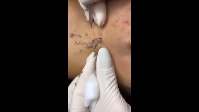 #9 БОЛЬШОЙ ЧИРЕЙ БОЛЬШОЙ ЧИРЯК БОЛЬШОЙ ПРЫЩ БОЛЬШОЙ ГНОЙНИК МНОГО ГНОЯ!!!!!