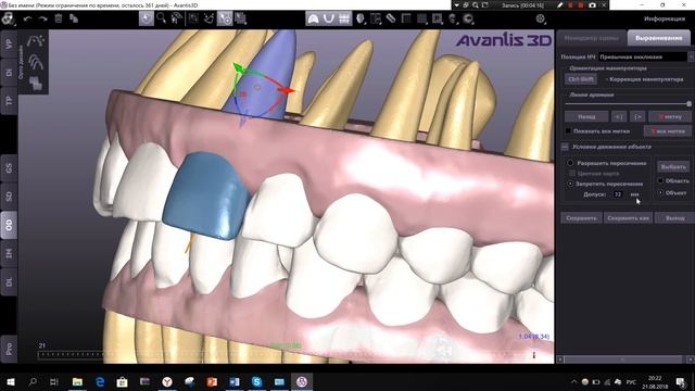Обучающее видео от Avantis3D -  выравнивание зубов