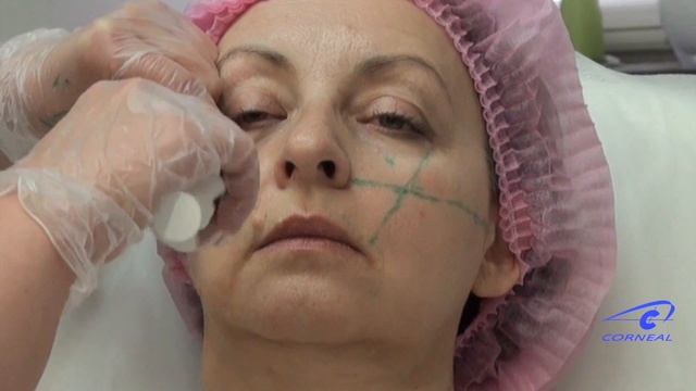 Вводим канюлю под круговую мышцу