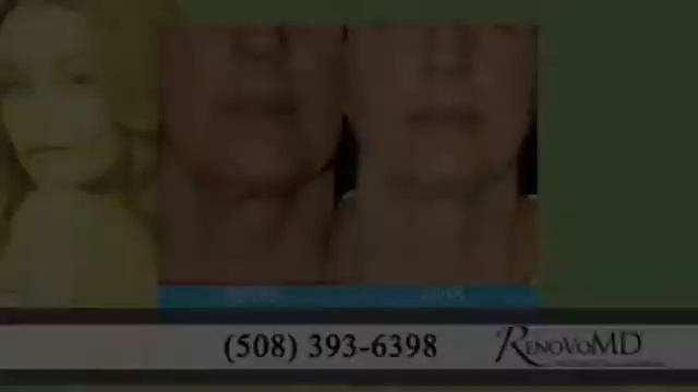 Exilis Reviews MA | Dr. Jean Casello Of RenovoMD 508-393-6398