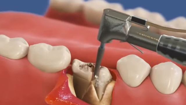 Атрофия после сложного удаления без подсадки кости