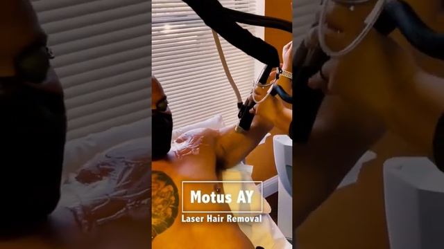 Laser HAIR REMOVAL with Deka Motus AY #shorts
