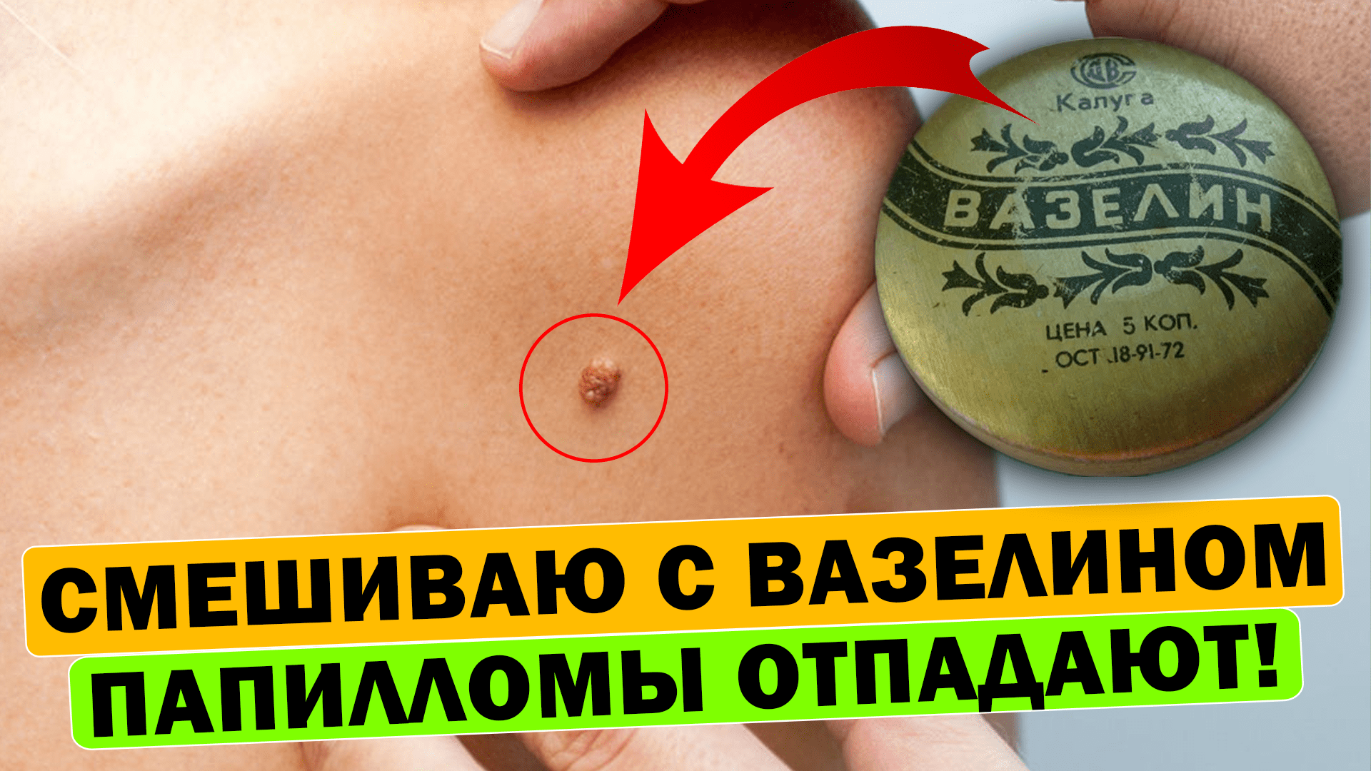 Папилломы, бородавки, кондиломы и другие образования на коже боятся этого средства! #папилломы