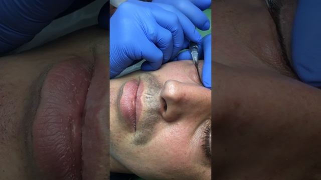 Мезотерапия и биоревитализация. Мезотерапия лица. Практика.